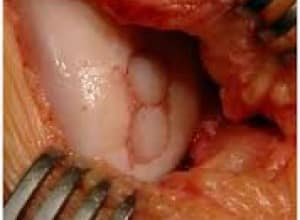 lesión osteocondral del astrágalo síntomas de diabetes
