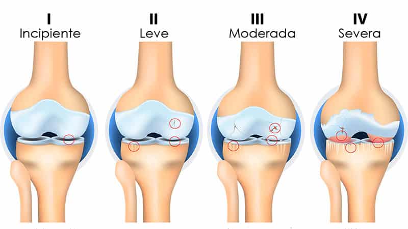 Usos de células madre en rodilla