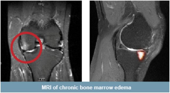 La edema óseo rodilla artroscopia en tras