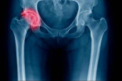 El riesgo de sufrir una fractura de cadera