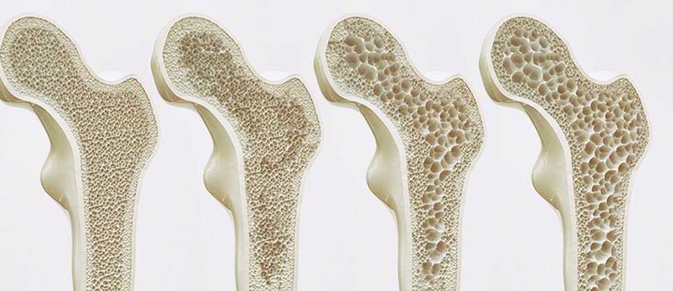 tipos de osteoporosis