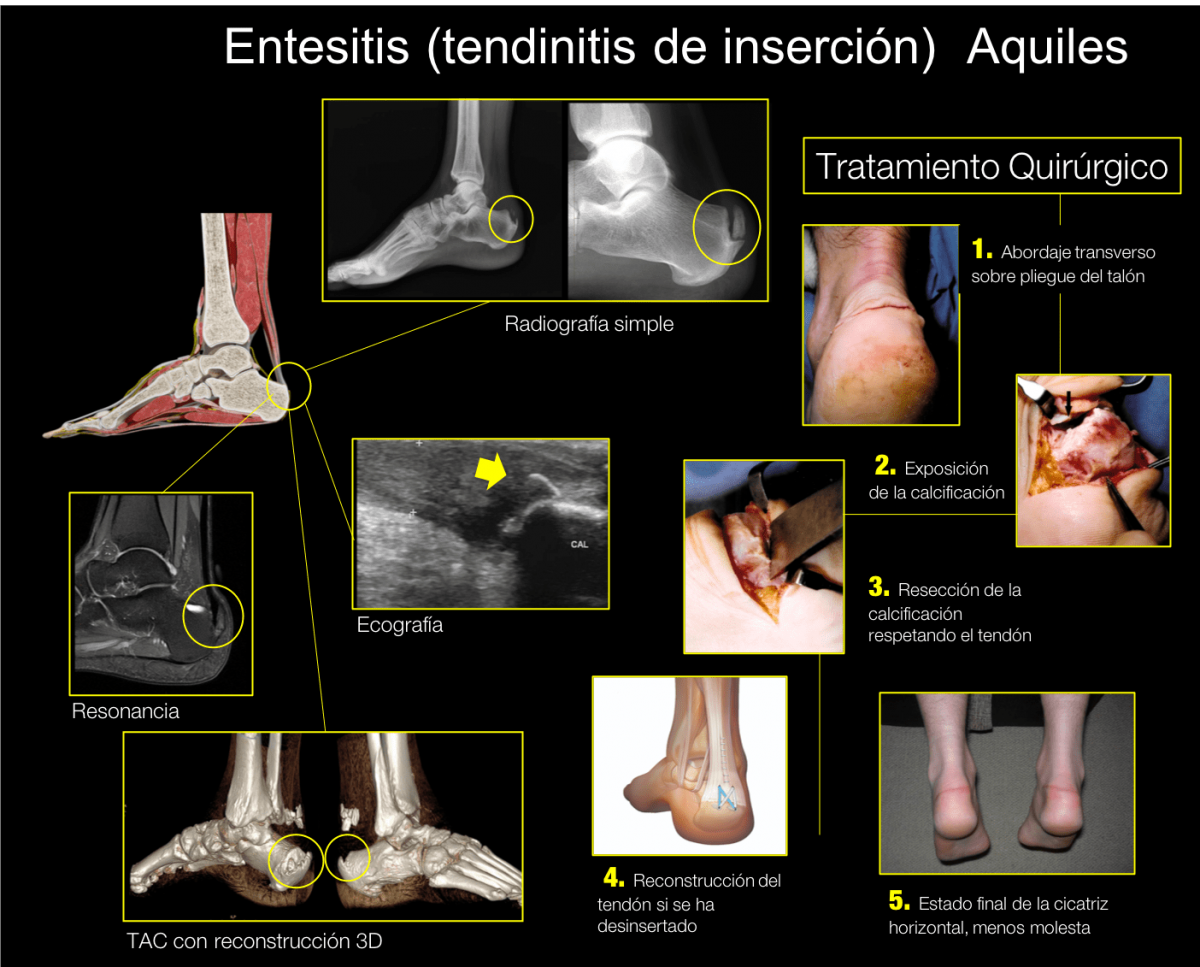 Traumat Logo Para Tendinitis De Aquiles Camde