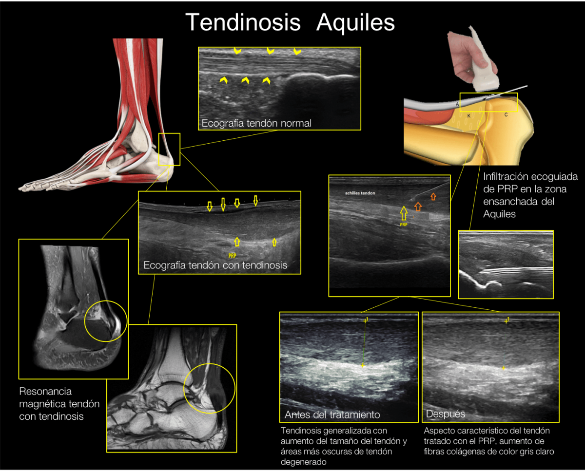 Traumatólogo Para Tendinitis De Aquiles - CAMDE