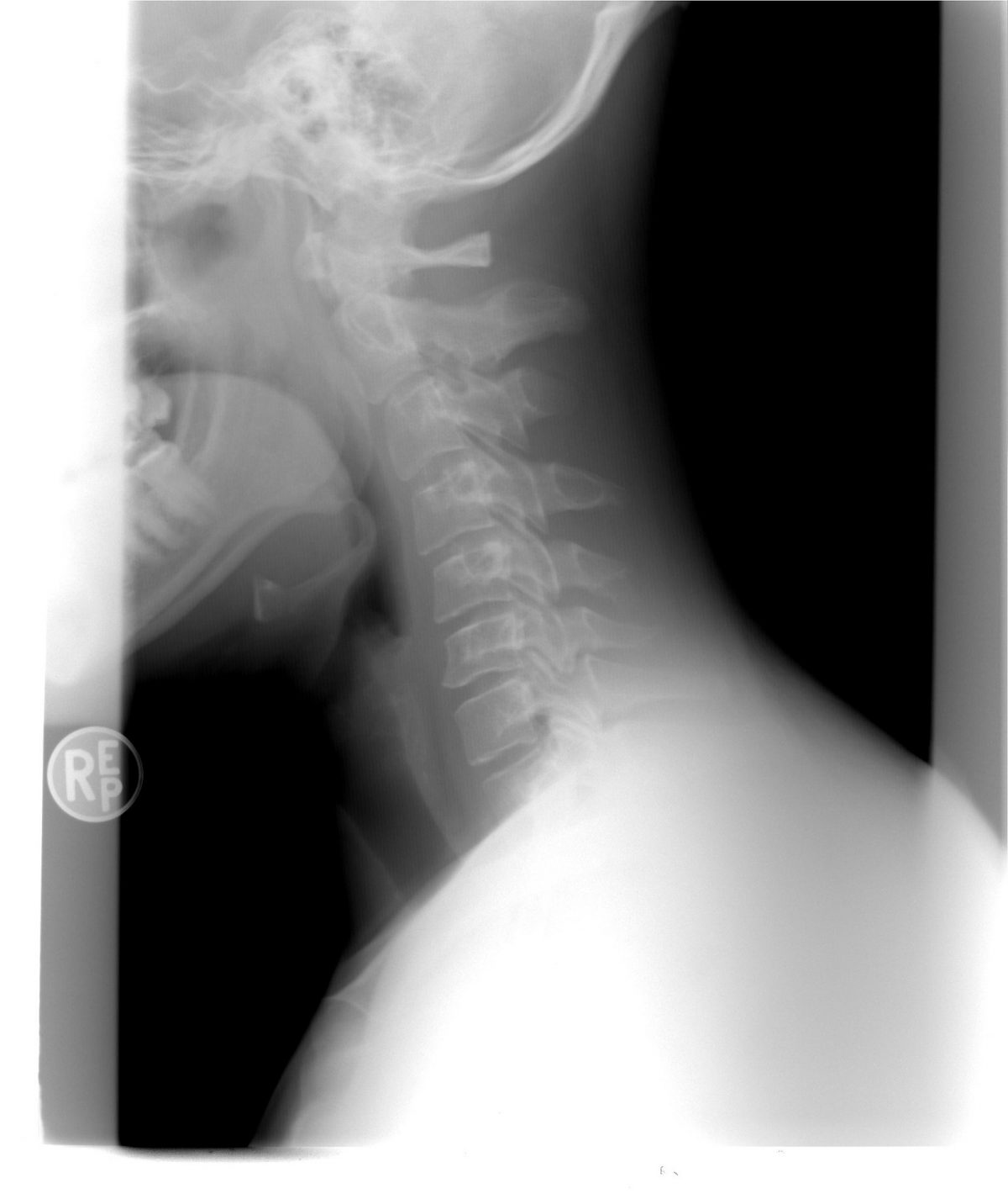 Latigazo Cervical Síntomas Secuelas Y Tratamiento Camde 1092