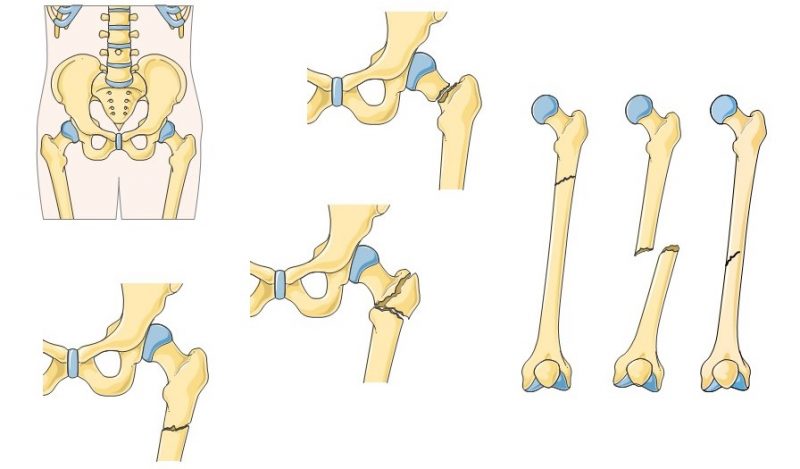 Fractura De Fémur Causas Y Tratamiento Camde Málaga