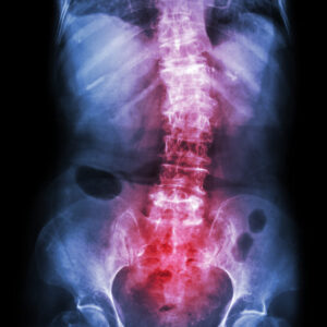espondilolistesis causas