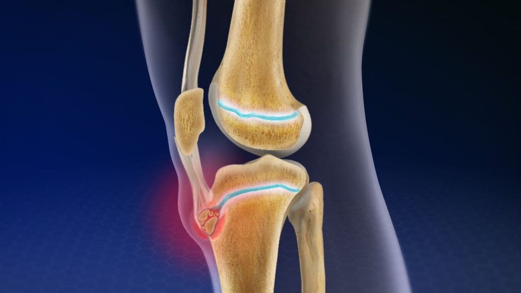 Enfermedad de Osgood-Schlatter