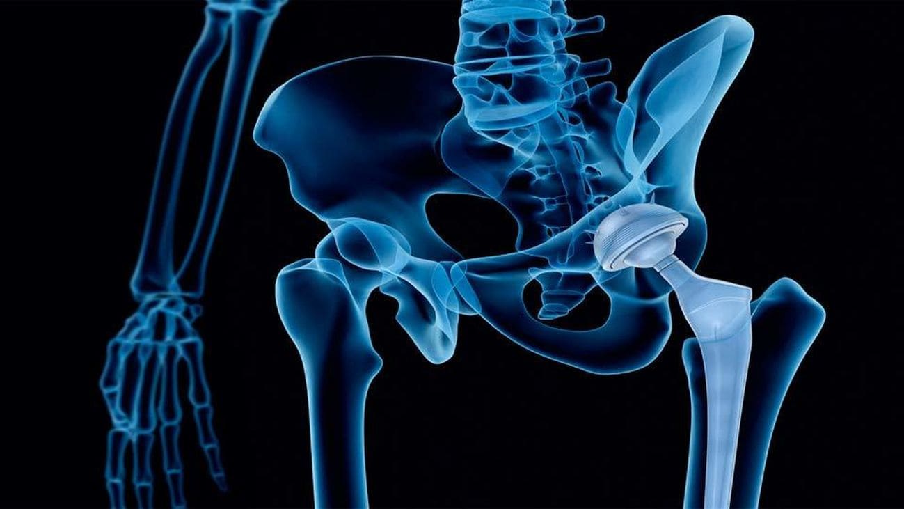 Qué es la prótesis de cadera y cuándo usarla