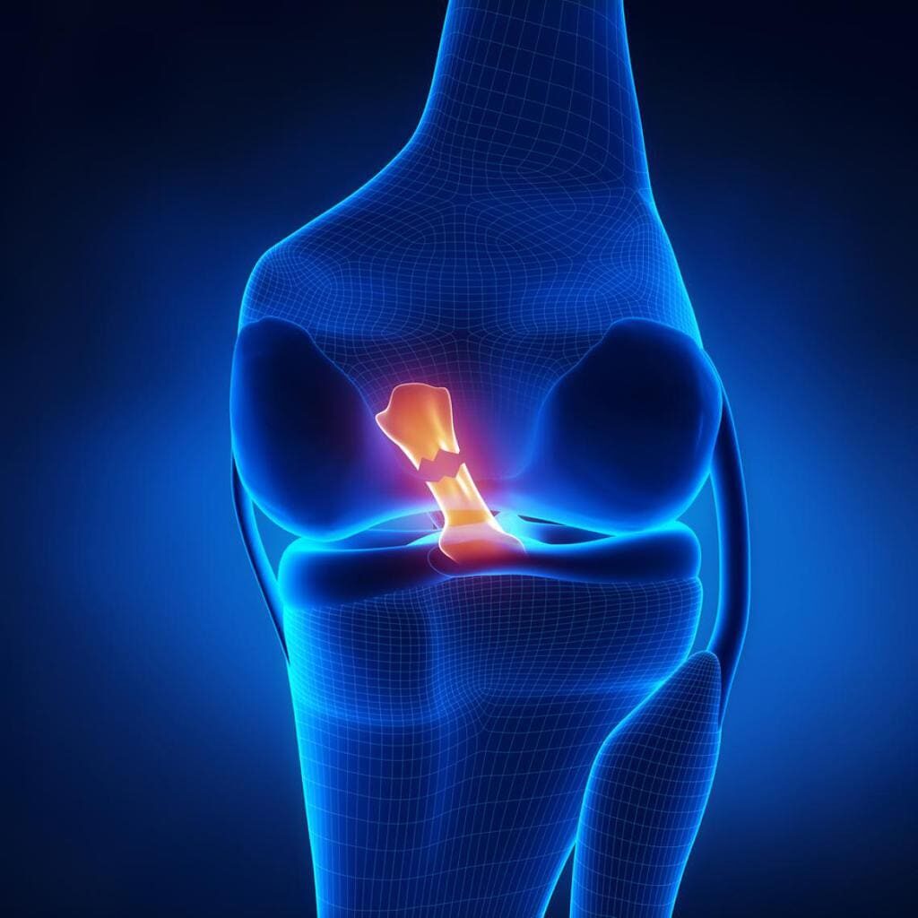 reconstrucción del ligamento cruzado anterior