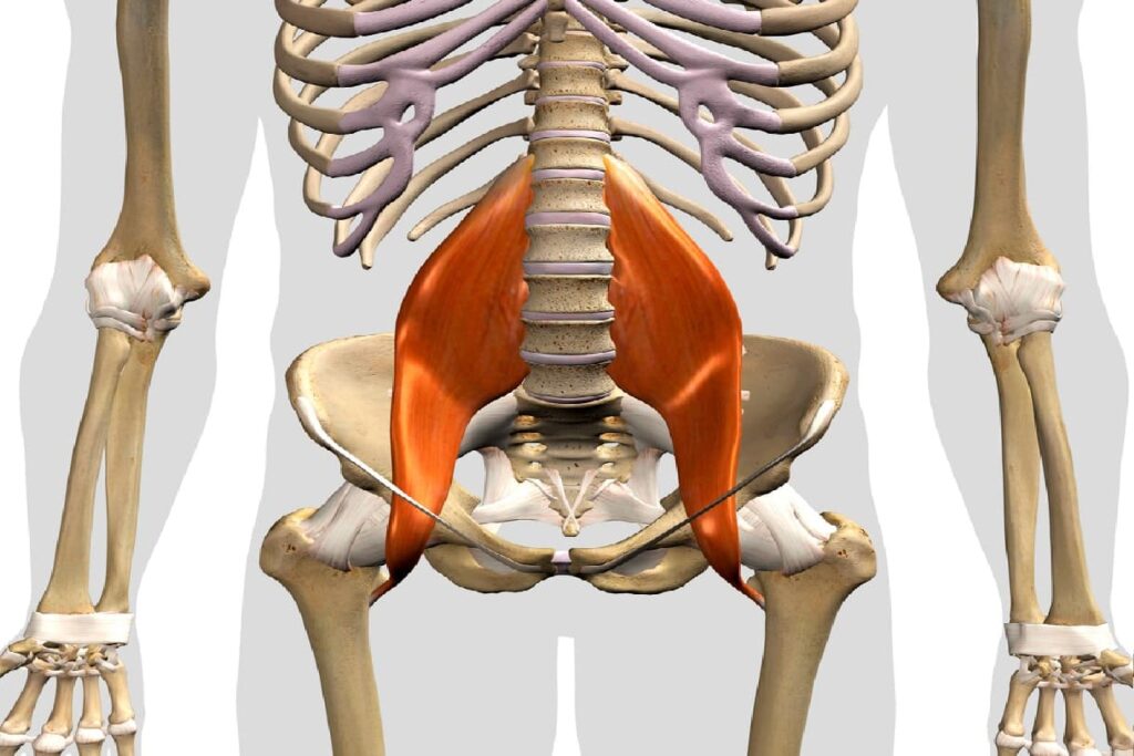 rotura del psoas