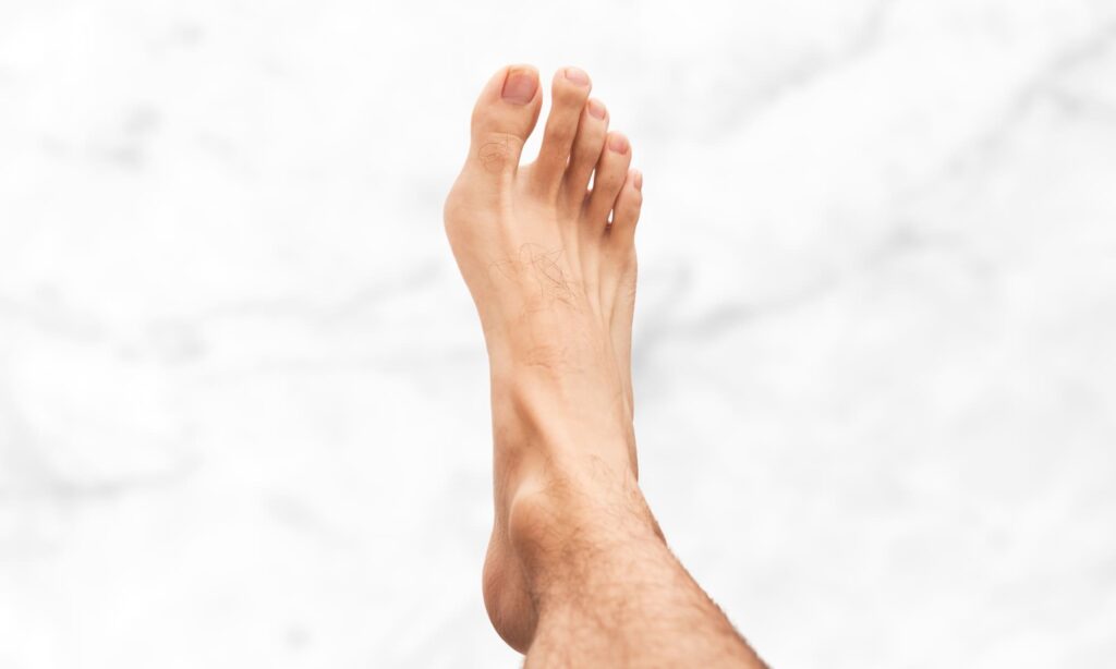Juanetes (Hallux Valgus)